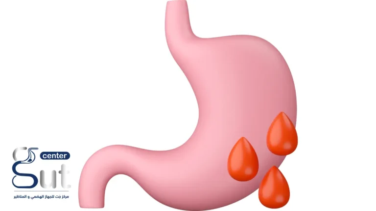 علاج نزيف المعدة بالمنظار