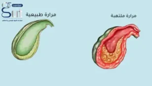 شكل المرارة الملتهبة 